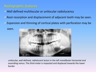 Radiographic features
Well defined multilocular or unilocular radiolucency
Root resorption and displacement of adjacent teeth may be seen.
Expansion and thinning of cortical plates with perforation may be
seen.
unilocular, well defined, radiolucent lesion in the left mandibular horizontal and
ascending ramus. The third molar is impacted and displaced towards the lower
border
 