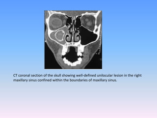 CT coronal section of the skull showing well-defined unilocular lesion in the right
maxillary sinus confined within the boundaries of maxillary sinus.
 