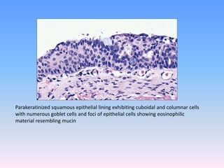 Parakeratinized squamous epithelial lining exhibiting cuboidal and columnar cells
with numerous goblet cells and foci of epithelial cells showing eosinophilic
material resembling mucin
 