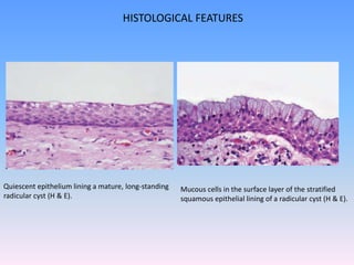 HISTOLOGICAL FEATURES
Quiescent epithelium lining a mature, long-standing
radicular cyst (H & E).
Mucous cells in the surface layer of the stratified
squamous epithelial lining of a radicular cyst (H & E).
 