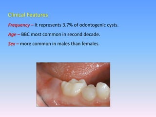 Clinical Features
Frequency – It represents 3.7% of odontogenic cysts.
Age – BBC most common in second decade.
Sex – more common in males than females.
 
