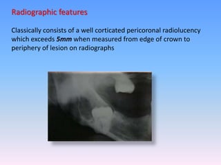 Radiographic features
Classically consists of a well corticated pericoronal radiolucency
which exceeds 5mm when measured from edge of crown to
periphery of lesion on radiographs
 