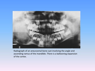 Radiograph of an aneurysmal bone cyst involving the angle and
ascending ramus of the mandible. There is a ballooning expansion
of the cortex.
 