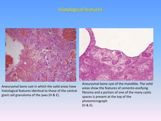 Histological features
Aneurysmal bone cyst in which the solid areas have
histological features identical to those of the central
giant cell granuloma of the jaws (H & E).
Aneurysmal bone cyst of the mandible. The solid
areas show the features of cemento-ossifying
fibroma and a portion of one of the many cystic
spaces is present at the top of the
photomicrograph
(H & E).
 