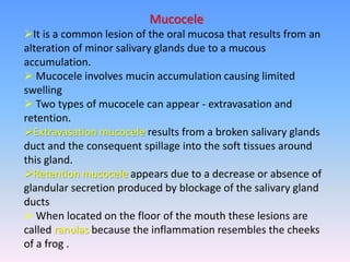 Mucocele
It is a common lesion of the oral mucosa that results from an
alteration of minor salivary glands due to a mucous
accumulation.
 Mucocele involves mucin accumulation causing limited
swelling
 Two types of mucocele can appear - extravasation and
retention.
Extravasation mucocele results from a broken salivary glands
duct and the consequent spillage into the soft tissues around
this gland.
Retention mucocele appears due to a decrease or absence of
glandular secretion produced by blockage of the salivary gland
ducts
 When located on the floor of the mouth these lesions are
called ranulas because the inflammation resembles the cheeks
of a frog .
 