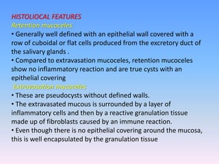 HISTOLIOCAL FEATURES
Retention mucoceles
• Generally well defined with an epithelial wall covered with a
row of cuboidal or flat cells produced from the excretory duct of
the salivary glands .
• Compared to extravasation mucoceles, retention mucoceles
show no inflammatory reaction and are true cysts with an
epithelial covering
Extravasation mucoceles
• These are pseudocysts without defined walls.
• The extravasated mucous is surrounded by a layer of
inflammatory cells and then by a reactive granulation tissue
made up of fibroblasts caused by an immune reaction.
• Even though there is no epithelial covering around the mucosa,
this is well encapsulated by the granulation tissue
 