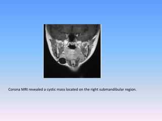 Corona MRI revealed a cystic mass located on the right submandibular region.
 