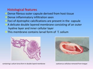 Histological features
Dense fibrous outer capsule derived from host tissue
Dense inflammatory infiltration seen
Foci of dystrophic calcifications are present in the capsule
A delicate double layered membrane consisting of an outer
hyaline layer and inner cellular layer
This membrane contains larval form of T. solium
cysticercus cellulose removed from tonguecontaining t.solium larva form in double layerd membrane
 