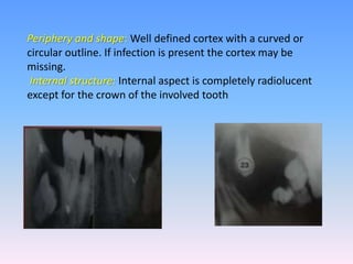 Periphery and shape: Well defined cortex with a curved or
circular outline. If infection is present the cortex may be
missing.
Internal structure: Internal aspect is completely radiolucent
except for the crown of the involved tooth
 
