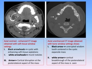 Axial contrast - enhanced CT image
obtained with soft-tissue window
settings
I. Black arrowheads => cystic with
enhancing soft-tissue septations
II. white arrowheads=> mural nodules
III. Arrow=> Cortical disruption at the
posterolateral aspect of the mass
Axial unenhanced CT image obtained
with bone window settings shows
I. Black arrow => unerupted wisdom
tooth centered in the cystic
expansile mass
II. white arrow=> cortical
breakthrough of the posterolateral
aspect of the mass is seen
 