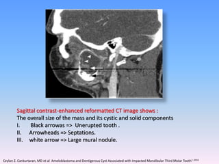 Sagittal contrast-enhanced reformatted CT image shows :
The overall size of the mass and its cystic and solid components
I. Black arrowas => Unerupted tooth .
II. Arrowheads => Septations.
III. white arrow => Large mural nodule.
Ceylan Z. Cankurtaran, MD et al Ameloblastoma and Dentigerous Cyst Associated with Impacted Mandibular Third Molar Tooth1 ;2010
 