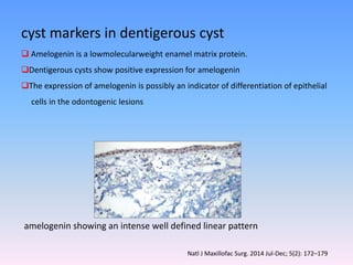 cyst markers in dentigerous cyst
 Amelogenin is a lowmolecularweight enamel matrix protein.
Dentigerous cysts show positive expression for amelogenin
The expression of amelogenin is possibly an indicator of differentiation of epithelial
cells in the odontogenic lesions
amelogenin showing an intense well defined linear pattern
Natl J Maxillofac Surg. 2014 Jul-Dec; 5(2): 172–179
 