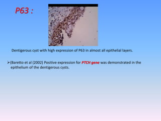 Dentigerous cyst with high expression of P63 in almost all epithelial layers.
P63 :
(Baretto et al (2002) Positive expression for PTCH gene was demonstrated in the
epithelium of the dentigerous cysts.
 