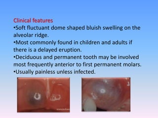 Clinical features
•Soft fluctuant dome shaped bluish swelling on the
alveolar ridge.
•Most commonly found in children and adults if
there is a delayed eruption.
•Deciduous and permanent tooth may be involved
most frequently anterior to first permanent molars.
•Usually painless unless infected.
 