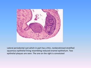 Lateral periodontal cyst which in part has a thin, nonkeratinised stratified
squamous epithelial lining resembling reduced enamel epithelium. Two
epithelial plaques are seen. The one on the right is convoluted
 