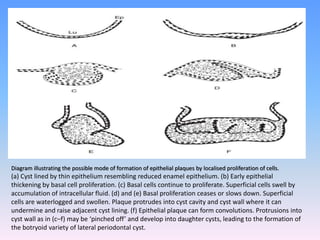 Diagram illustrating the possible mode of formation of epithelial plaques by localised proliferation of cells.
(a) Cyst lined by thin epithelium resembling reduced enamel epithelium. (b) Early epithelial
thickening by basal cell proliferation. (c) Basal cells continue to proliferate. Superficial cells swell by
accumulation of intracellular fluid. (d) and (e) Basal proliferation ceases or slows down. Superficial
cells are waterlogged and swollen. Plaque protrudes into cyst cavity and cyst wall where it can
undermine and raise adjacent cyst lining. (f) Epithelial plaque can form convolutions. Protrusions into
cyst wall as in (c–f) may be ‘pinched off’ and develop into daughter cysts, leading to the formation of
the botryoid variety of lateral periodontal cyst.
 