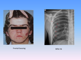 Frontal bossing Bifid rib
 