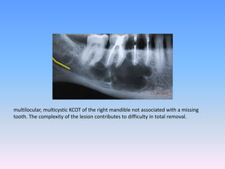 multilocular, multicystic KCOT of the right mandible not associated with a missing
tooth. The complexity of the lesion contributes to difficulty in total removal.
 