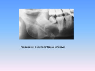 Radiograph of a small odontogenic keratocyst
 