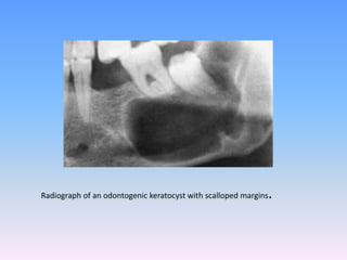 Radiograph of an odontogenic keratocyst with scalloped margins.
 