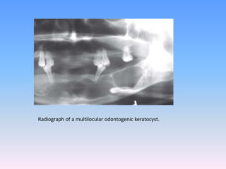 Radiograph of a multilocular odontogenic keratocyst.
 