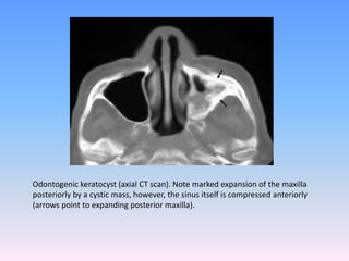 Odontogenic keratocyst (axial CT scan). Note marked expansion of the maxilla
posteriorly by a cystic mass, however, the sinus itself is compressed anteriorly
(arrows point to expanding posterior maxilla).
 