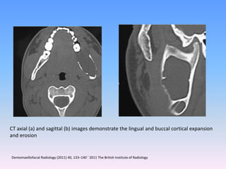 CT axial (a) and sagittal (b) images demonstrate the lingual and buccal cortical expansion
and erosion
Dentomaxillofacial Radiology (2011) 40, 133–140 ’ 2011 The British Institute of Radiology
 