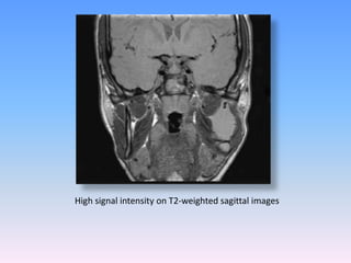 High signal intensity on T2-weighted sagittal images
 