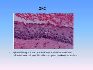 • Epithelial lining is 6 to 8 cells thick, with a hyperchromatic and
palisaded basal cell layer. Note the corrugated parakeratotic surface.
OKC
 