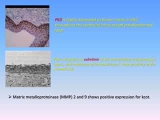 P63 is highly expressed as brown nuclei in OKC
throughout the epithelial lining except parakeratinized
layer
POKC. Positivity to calretinin of the intermediate and parabasal
layers, with negativity of the basal layers. Rare positivity of the
stromal cells
 Matrix metalloproteinase (MMP) 2 and 9 shows positive expression for kcot.
 