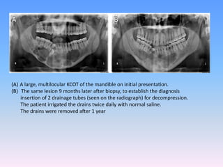 (A) A large, multilocular KCOT of the mandible on initial presentation.
(B) The same lesion 9 months later after biopsy, to establish the diagnosis
insertion of 2 drainage tubes (seen on the radiograph) for decompression.
The patient irrigated the drains twice daily with normal saline.
The drains were removed after 1 year
 