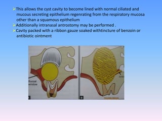 This allows the cyst cavity to become lined with normal ciliated and
mucous secreting epithelium regenrating from the respiratory mucosa
other than a squamous epithelium
Additionally intranasal antrostomy may be performed .
Cavity packed with a ribbon gauze soaked withtincture of benzoin or
antibiotic ointment
 
