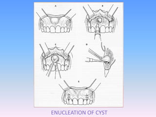 ENUCLEATION OF CYST
 