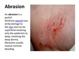 Abrasion
An abrasion is a
partial
thickness wound caus
ed by damage to
the skin and can be
superficial involving
only the epidermis to
deep, involving the
deep dermis.
Abrasions usually
involve minimal
bleeding.
 