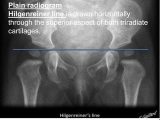Plain radiogram
Hilgenreiner line is drawn horizontally
through the superior aspect of both triradiate
cartilages.
 