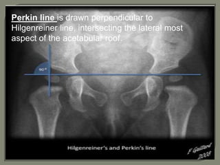 Perkin line is drawn perpendicular to
Hilgenreiner line, intersecting the lateral most
aspect of the acetabular roof.
 