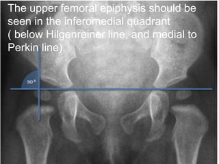 The upper femoral epiphysis should be
seen in the inferomedial quadrant
( below Hilgenreiner line, and medial to
Perkin line).
 