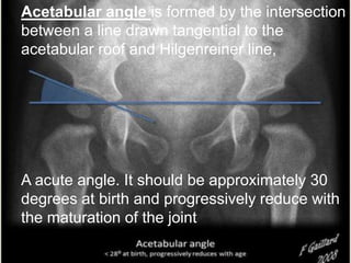 Acetabular angle is formed by the intersection
between a line drawn tangential to the
acetabular roof and Hilgenreiner line,
A acute angle. It should be approximately 30
degrees at birth and progressively reduce with
the maturation of the joint
 