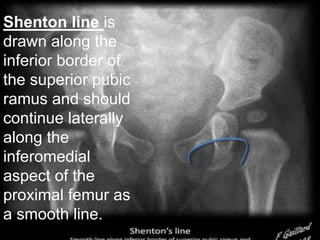 Shenton line is
drawn along the
inferior border of
the superior pubic
ramus and should
continue laterally
along the
inferomedial
aspect of the
proximal femur as
a smooth line.
 