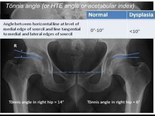 Tönnis angle (or HTE angle or acetabular index)
 
