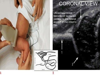 Ultrasound linear
transducer is placed
parallel to the lateral
aspect of the infant’s
hip.
CORONAL VIEW
 