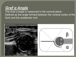 Graf α Angle
The Graf α angle is measured in the coronal plane
Defined as the angle formed between the vertical cortex of the
ilium and the acetabular roof.
 