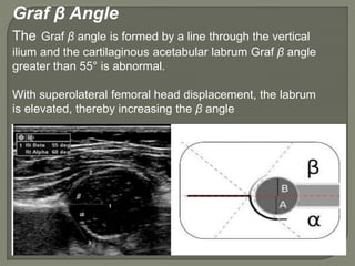 Graf β Angle
The Graf β angle is formed by a line through the vertical
ilium and the cartilaginous acetabular labrum Graf β angle
greater than 55° is abnormal.
With superolateral femoral head displacement, the labrum
is elevated, thereby increasing the β angle
 