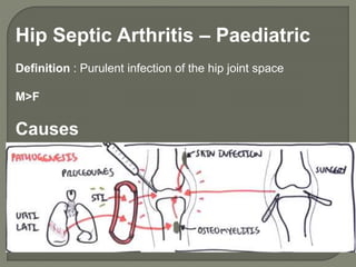 Hip Septic Arthritis – Paediatric
Definition : Purulent infection of the hip joint space
M>F
Causes
 
