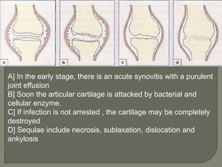 A] In the early stage, there is an acute synovitis with a purulent
joint effusion
B] Soon the articular cartilage is attacked by bacterial and
cellular enzyme.
C] If infection is not arrested , the cartilage may be completely
destroyed
D] Sequlae include necrosis, sublaxation, dislocation and
ankylosis
 