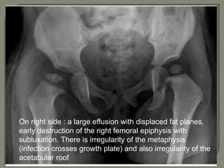 On right side : a large effusion with displaced fat planes,
early destruction of the right femoral epiphysis with
subluxation. There is irregularity of the metaphysis
(infection crosses growth plate) and also irregularity of the
acetabular roof
 
