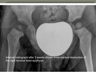 Interval radiograph after 2 weeks shows more marked destruction of
the right femoral head epiphysis.
 