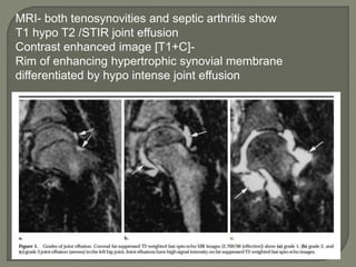 MRI- both tenosynovities and septic arthritis show
T1 hypo T2 /STIR joint effusion
Contrast enhanced image [T1+C]-
Rim of enhancing hypertrophic synovial membrane
differentiated by hypo intense joint effusion
 