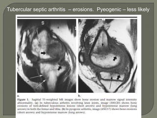 Tubercular septic arthritis – erosions. Pyeogenic – less likely
 