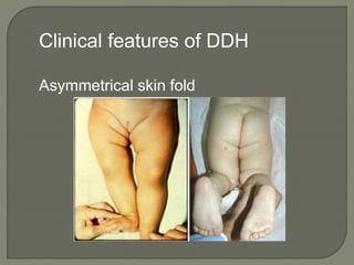 Clinical features of DDH
Asymmetrical skin fold
 